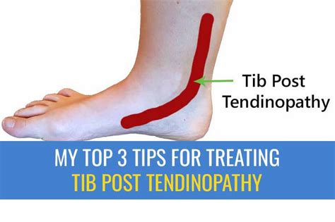 My Top Tips For Treating Tibialis Posterior Tendinopathy Sports Injury Physio