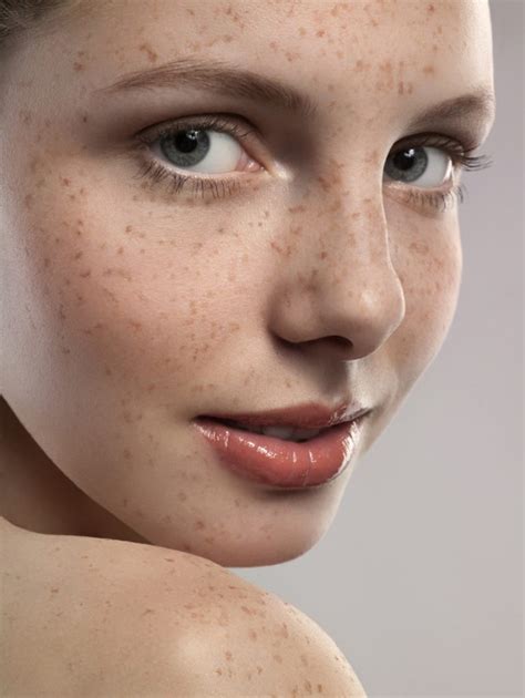 Five Ways To Deal With Freckles Welcome To The Scene