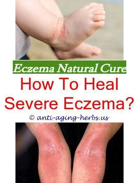 Eczema And Diet Body Wash For Eczema Skin Good Shampoo For Eczemais