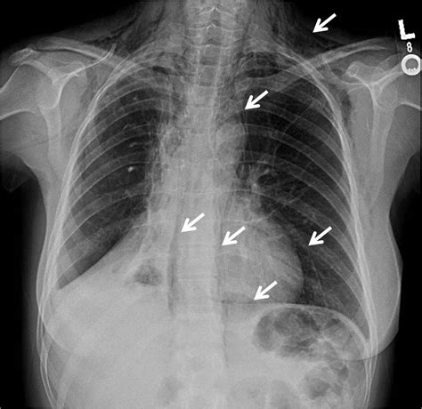 Non Neoplastic Disorders Of The Mediastinum Pneumomediastinum Pulmonology Advisor