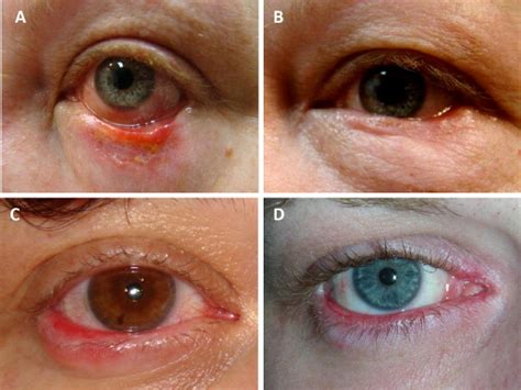 Periorbital Discoid Lupus Erythematosus Ophthalmology