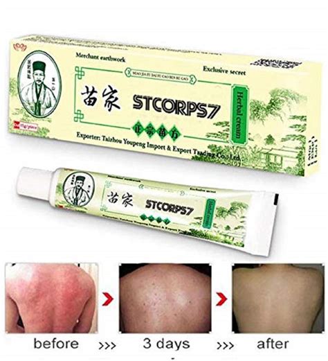 Psoriasis Treatment Stcorps7 Psoriasis Cream For Dermatitis Eczema