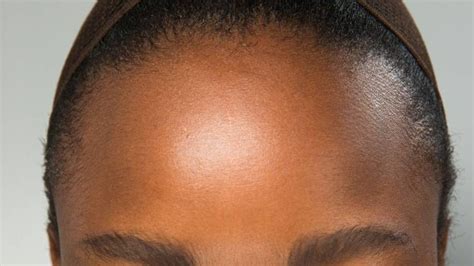 How To Treat Hyperpigmentation In Darker Skin Tones British Vogue