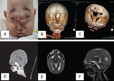 Immediate Resection And Reconstruction Of Encephalocele In T