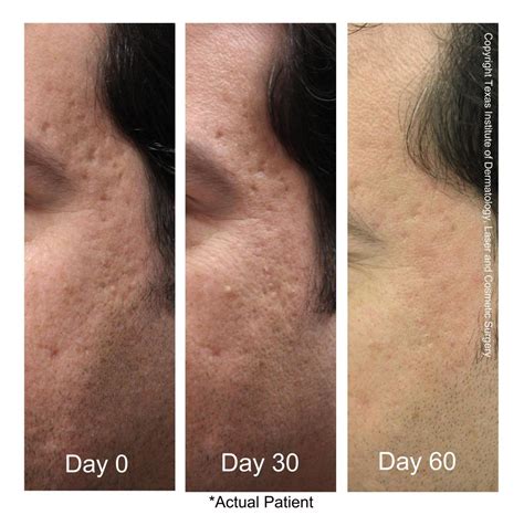 Typical Laser Results Scar Treatments