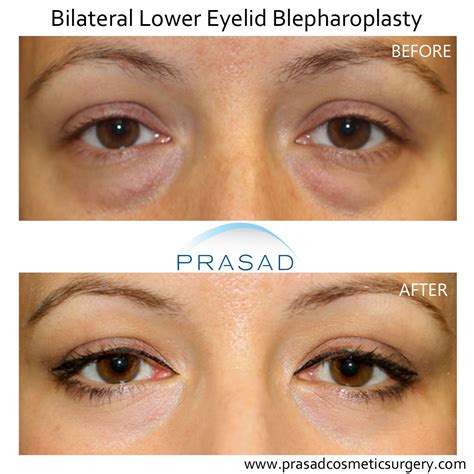 Eye Lift Surgery Before After Patient Photos Prasad Cosmetic Surgery