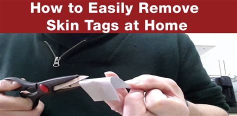 How To Easily Remove Skin Tags At Home