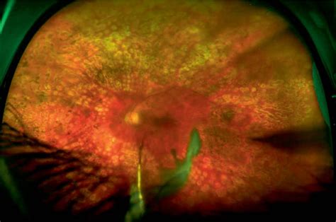 Optomap Uwf Colour Fundus Image Of Same Eye In Figure 1 Prior To