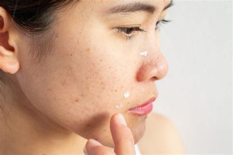 What Is Acne Prone Skin 10 Tips To Improve It The Frisky