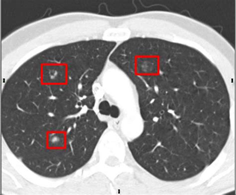 Ct Lung Anatomy