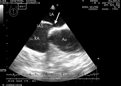 When And How To Diagnose Patent Foramen Ovale Heart