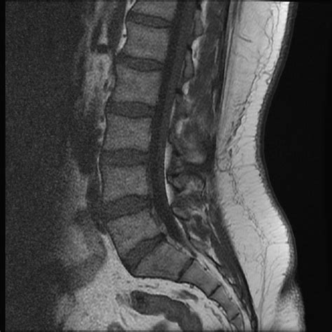 How To Read Mri Images Of Lumbar Spine Scubahooli