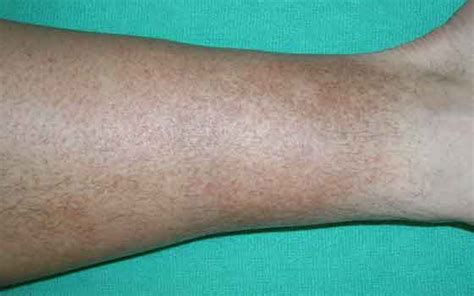 Brown Skin Discoloration On Lower Legs Ankles Face And Neck Women