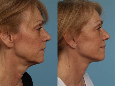 Neck Lift Before And After Photos Patient 279 Chicago Il Tlkm