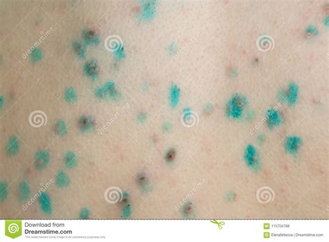 Painful Pimples On The Body Close Up Treated With A Solution Of