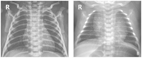 A Representative Chest X Ray Of A Normal Non Infected Neonate B Download Scientific