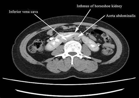 A Deadly Trap For Para Aortic Lymph Node Dissection In Patients With