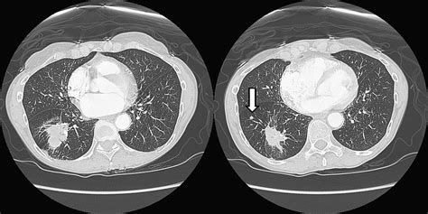 Additional Pulmonary Nodules In The Patient With Lung Cancer