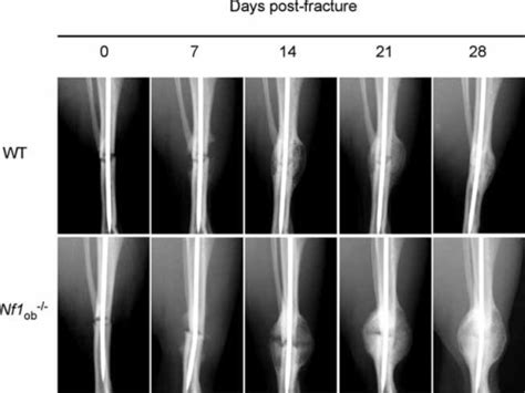 The fracture healing process begins with soft tissue that is gradually replaced with firmer, more defined materials. Lack of Nf1 specifically in osteoblasts delays bone hea ...