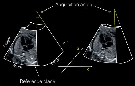 Three And Four Dimensional Ultrasound Of The Fetal Heart Obgyn Key