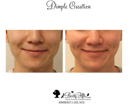 Dimple Creation Before And After Photos Dr Kimberly Lee