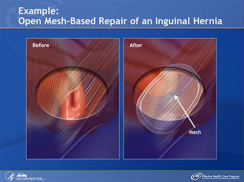 Inguinal Hernia Repair Schmidt National Law Group