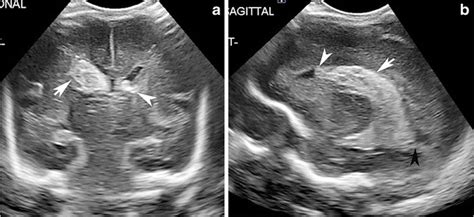 Grade 3 Intraventricular Hemorrhage Ivh Head Us Examination Coronal