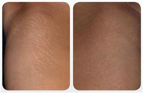 Stretch Marks The Letter Of Recomendation