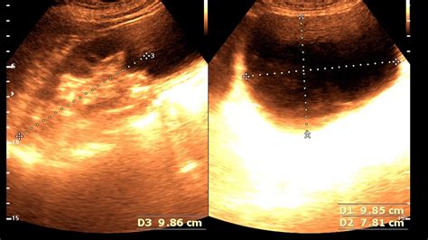 Ultrasound Cases 444 Of 2000 Large Single Right Renal Cortical Cyst
