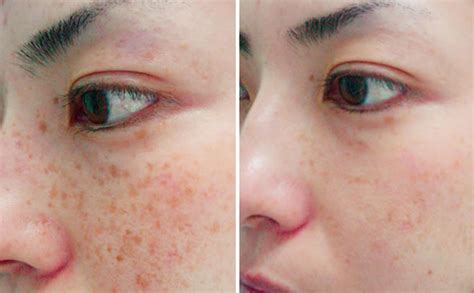 Types Of Laser Therapy For Acne Scars And Hyperpigmentation Justinboey