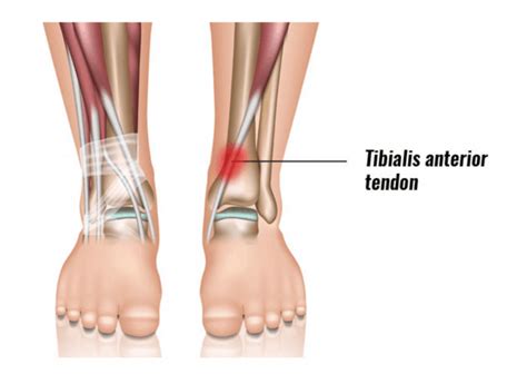 Anterior Tibial Tendonitis Foot And Ankle Specialists Of The Mid Atlantic