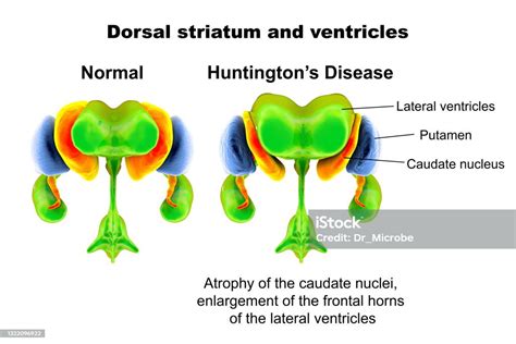 Dorsal Striatum And Lateral Ventricles Normal And In Huntingtons