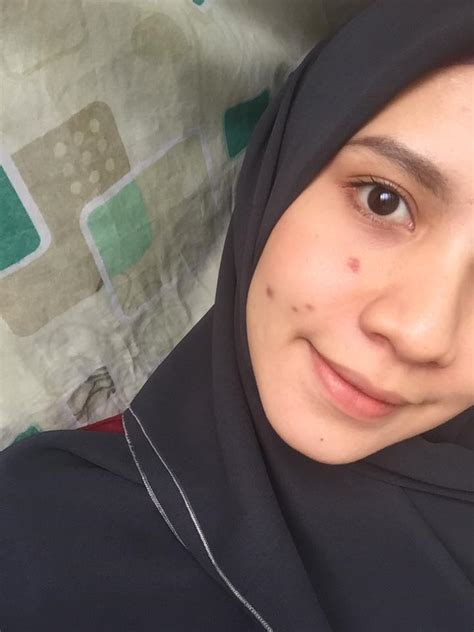 Rawatan laser jenis ini boleh menembusi lebih mendalam ke dalam kulit daripada kaedah. Wanita Ini Kongsi Caranya Hilangkan Parut Jerawat Dengan ...