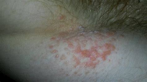 Itchy Red Bumps Under Armpits Days After Sex With My Skin