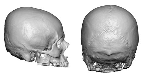 The normal curves are termed lordosis and kyphosis. Plastic Surgery Case Study - Custom Skull Implant for Flat Back of the Head - Explore Plastic ...