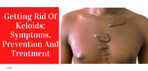 Getting Rid Of Keloids Symptoms Prevention And Treatment