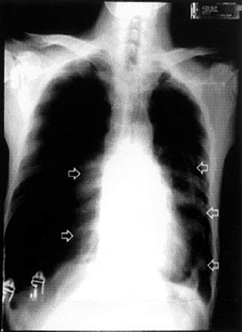 Bilateral Spontaneous Pneumothorax—the Case For Prompt Chest