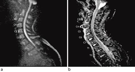 Fibrocartilaginous Embolism As A Cause Of Anterior Spinal Artery