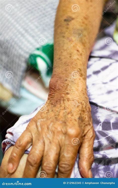 Bruise Wounded Skin Texture Of Old Asian Woman Right Arm Stock Image