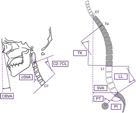 Figure Schematic Of The Measured Sagittal Alignment Parameters For The