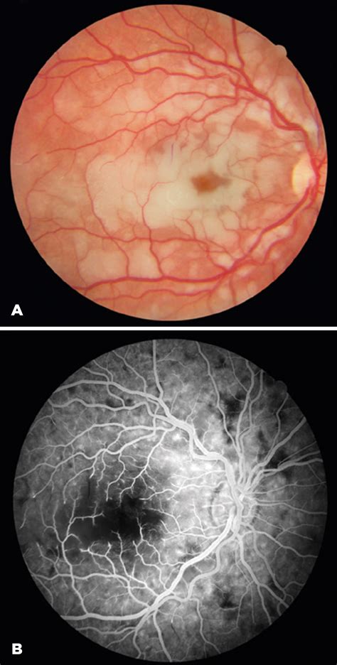 Scielo Brasil Retinal Ischemia Following Mandible Tumor Treatment
