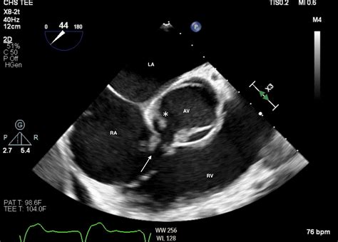 Cureus Acquired Gerbode Defect In A Patient With Infective