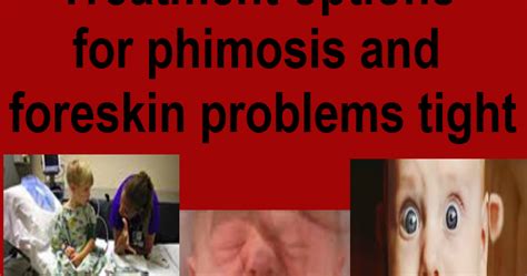 1 Of Th Best Of Treatment Options For Phimosis And Foreskin Problems Tight
