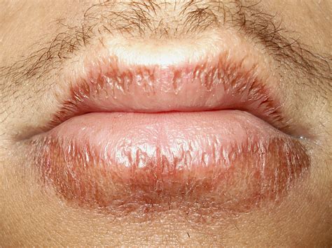 Lip Licking Dermatitis Droge Lippen