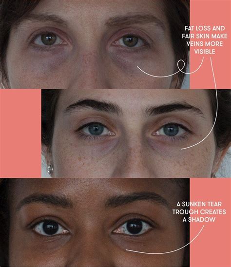 Puffy Eyes Dark Circles And Bags Dermatologists Explain The