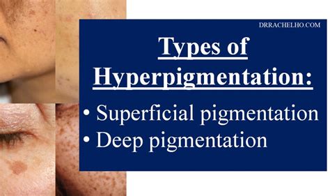 Dr Rachel Ho Hyperpigmentation Disorders Causes Types Treatments