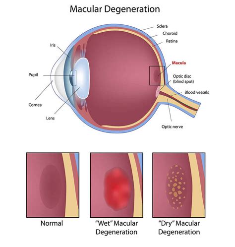 Retina Orange County Macular Degeneration Harvard Eye