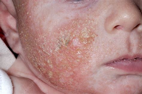 Infected Eczema Stock Image M1500266 Science Photo Library