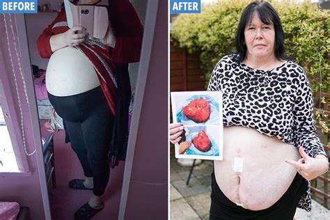 Mum Of Four Discovers Giant Two Stone Cyst On Her Ovary Which Started Growing After The Birth Of