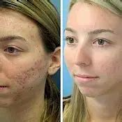 Acne Treatments Acne Specialists Same Day Appointments